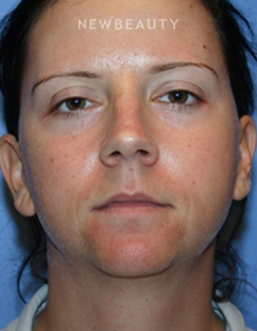 Dr. Kelly Bomer - Liquid Facelift - Before
