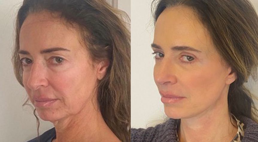 French face lift before and after