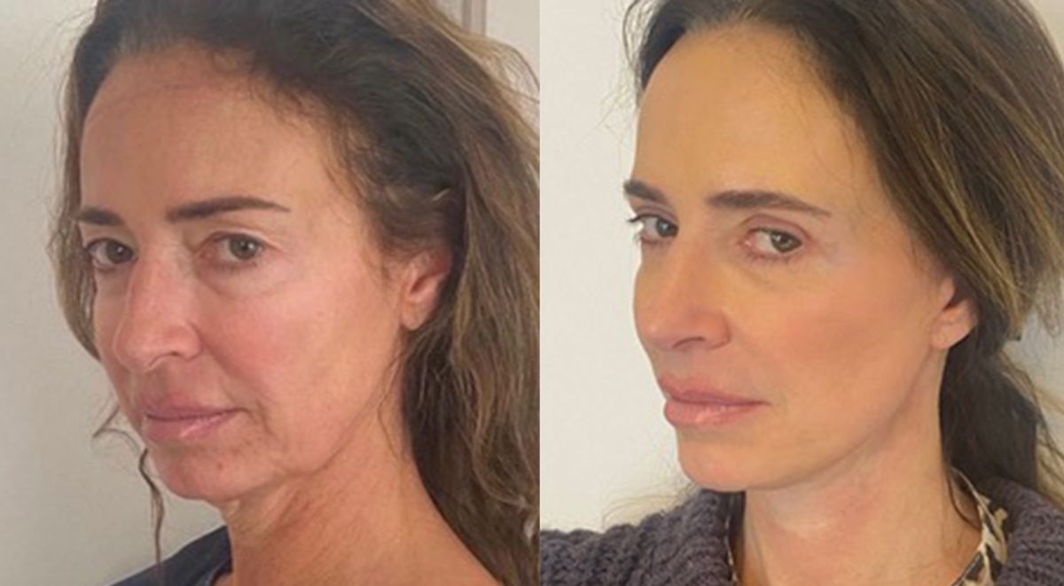 French face lift before and after