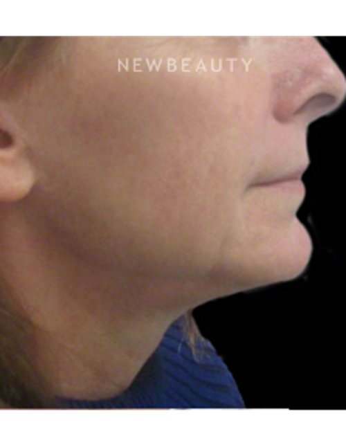 Dr. Kally Papantoniou - Ulthera - After