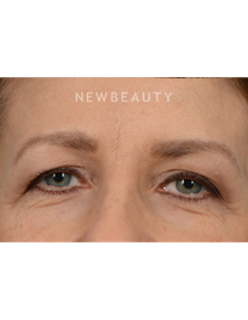 Dr. Jeffrey Wise - Eyelift - Before