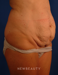 Dr. Peter Geldner Abdominoplasty - Before