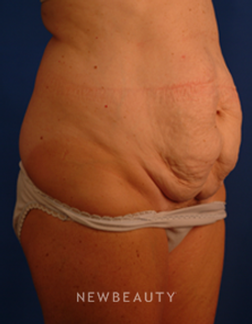 Dr. Peter Geldner Abdominoplasty - Before