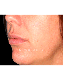 Dr. Kelly Bomer Lip Augmentation - After