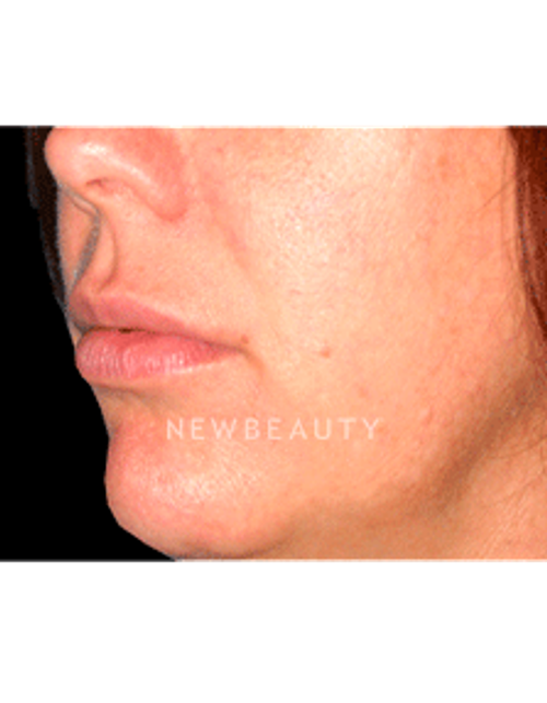 Dr. Kelly Bomer Lip Augmentation - After