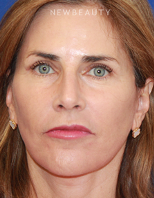 Dr. Dilip Madnani - Facelift - After