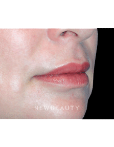 Dr. Kelly Bomer Lip Augmentation - After