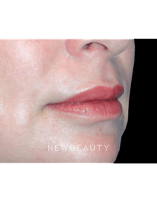Dr. Kelly Bomer Lip Augmentation - After