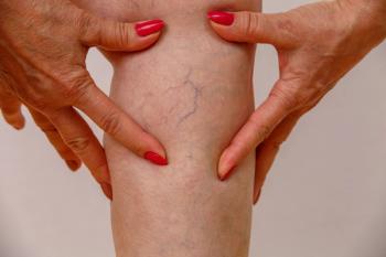 picture of spider veins