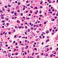 Multiple myeloma