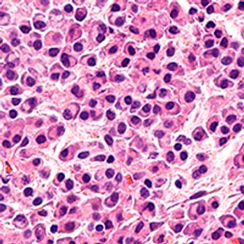 Multiple myeloma