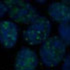 PARP Inhibitors May Help Fight Colon Cancer