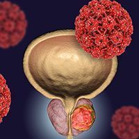 Prostate Cancer