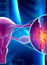 Cadonilimab plus chemotherapy in cervical cancer|   image credit: © phetchara - stock.adobe.com