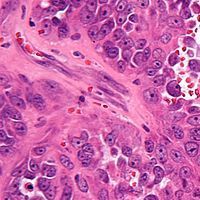 Camsirubicin Elicits Early Clinical Activity in Advanced Soft Tissue Sarcoma