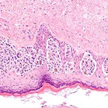 Adjuvant Pembrolizumab in Stage III Melanoma | Image Credit: © David A Litman - stock.adobe.com