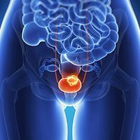 bladder cancer