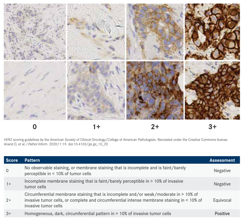 Metastatic Breast Cancer Enters a New Era of HER2 Classification