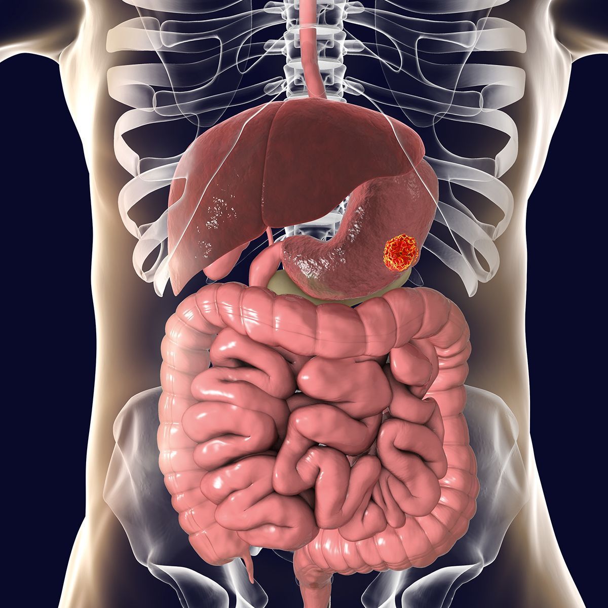 The safety and tolerability of TST001 is under investigation as a potential treatment option for patients with gastric/gastroesophageal junction cancer and other locally advanced or metastatic solid tumors as part of a phase 1 trial.