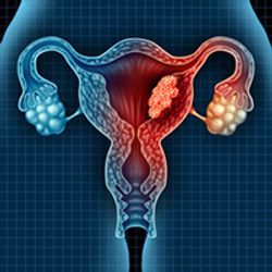 Anlotinib/Sintilimab Combo Confers Long-Term OS Benefit in Advanced Cervical Cancer