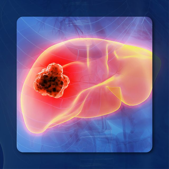 Systemic therapy in HCC