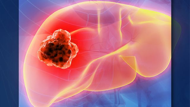 Systemic therapy in HCC