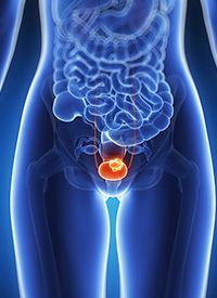 Urothelial Cancer