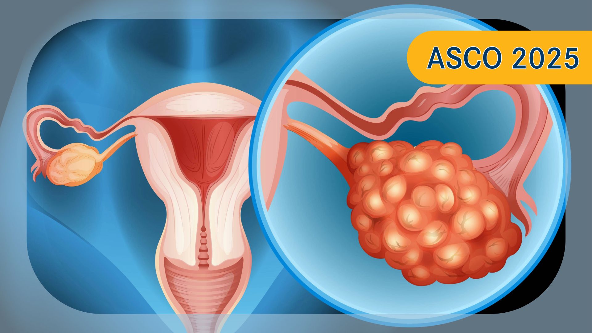 Relacorilant Combo in Ovarian Cancer | Image Credit: ©blueringmedia - stock.adobe.com