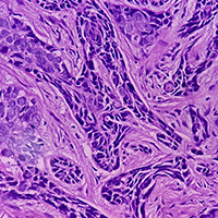 Time to Treatment Initiation Affected by Demographics, Socioeconomics in Solid Tumors