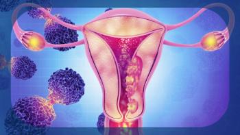 Advanced Cervical Cancer | Image credit:  © Crystal light - stock.adobe.com