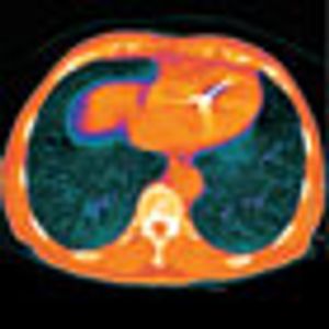 A Leap in Lung Cancer Care: Early-Screening Success Prompts Push for Change
