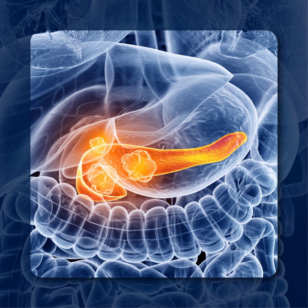 FOLFIRINOX in Metastatic PDAC | Image Credit: © Sebastian Kaulitzki – stock.adobe.com