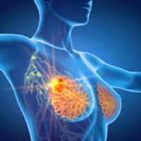 Neoadjuvant Pegylated Liposomal Doxorubicin Regimen Has Promising Efficacy in HER2+ Breast Cancer