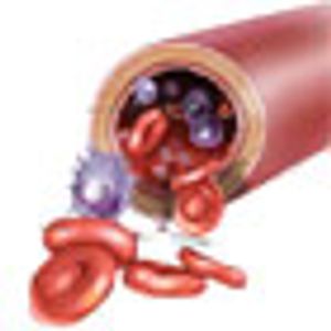 Amonafide Plus Cytarabine Fails To Meet Primary Endpoint