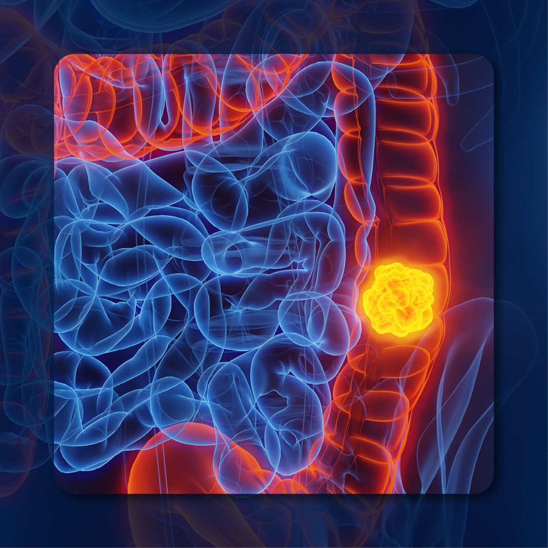 Colorectal Cancer | Image Credit:  © Sebastian Kaulitzki – stock.adobe.com