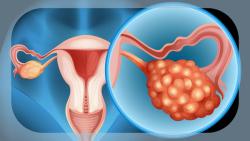 FDA Receives NDA for Relacorilant in Platinum-Resistant Ovarian Cancer