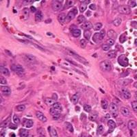 Trabectedin/Durvalumab Shows Early Activity, Demonstrates Feasibility for Soft Tissue Sarcoma