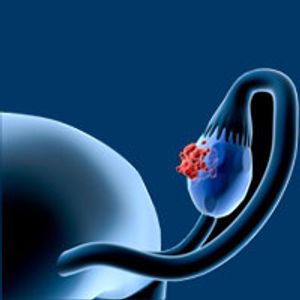 Study Explores Correlations Among Irregular Menstrual Cycles, PCOS, and Ovarian Cancer Risk