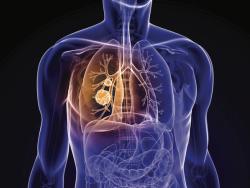 Navigating the Evolving Treatment Landscape in HER2 Non–Small Cell Lung Cancer