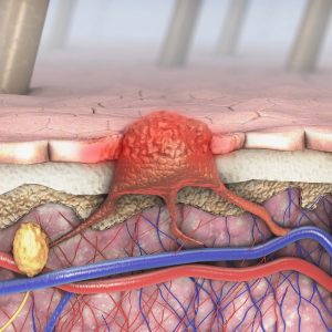 Cabozantinib/Pembrolizumab Trial Poised to Improve Efficacy, Safety in Advanced Melanoma