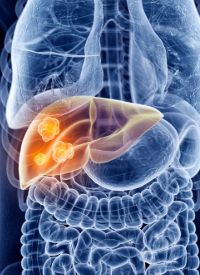 Hepatocellular Carcinoma | Image credit:   © Sebastian Kaulitzki - stock.adobe.com