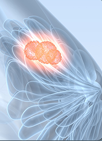 Breast Cancer | Image Credit: © Axel Kock – stock.adobe.com