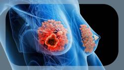 Novel ADC IBI354 Drives Responses in Pretreated HER2+ Advanced Breast Cancer