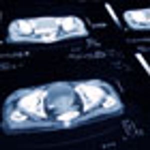 Newly Published Results Show Survival Benefit with Enzalutamide in Prostate Cancer