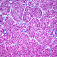 Hepatocellular Carcinoma