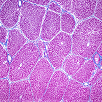 Hepatocellular Carcinoma