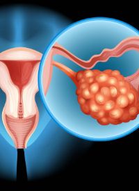 Relacorilant Combo in Ovarian  Cancer | Image Credit: ©blueringmedia  - stock.adobe.com
