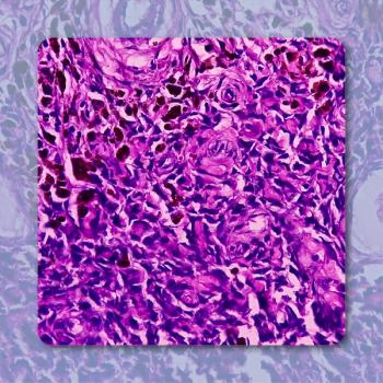 SON-1010 Plus Trabectedin in Advanced Leiomyosarcoma/Liposarcoma | Image Credit: © MdBabul– stock.adobe.com