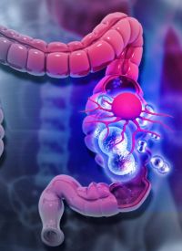  Metastatic colorectal cancer|   Image Credit: © Rasi - stock.adobe.com