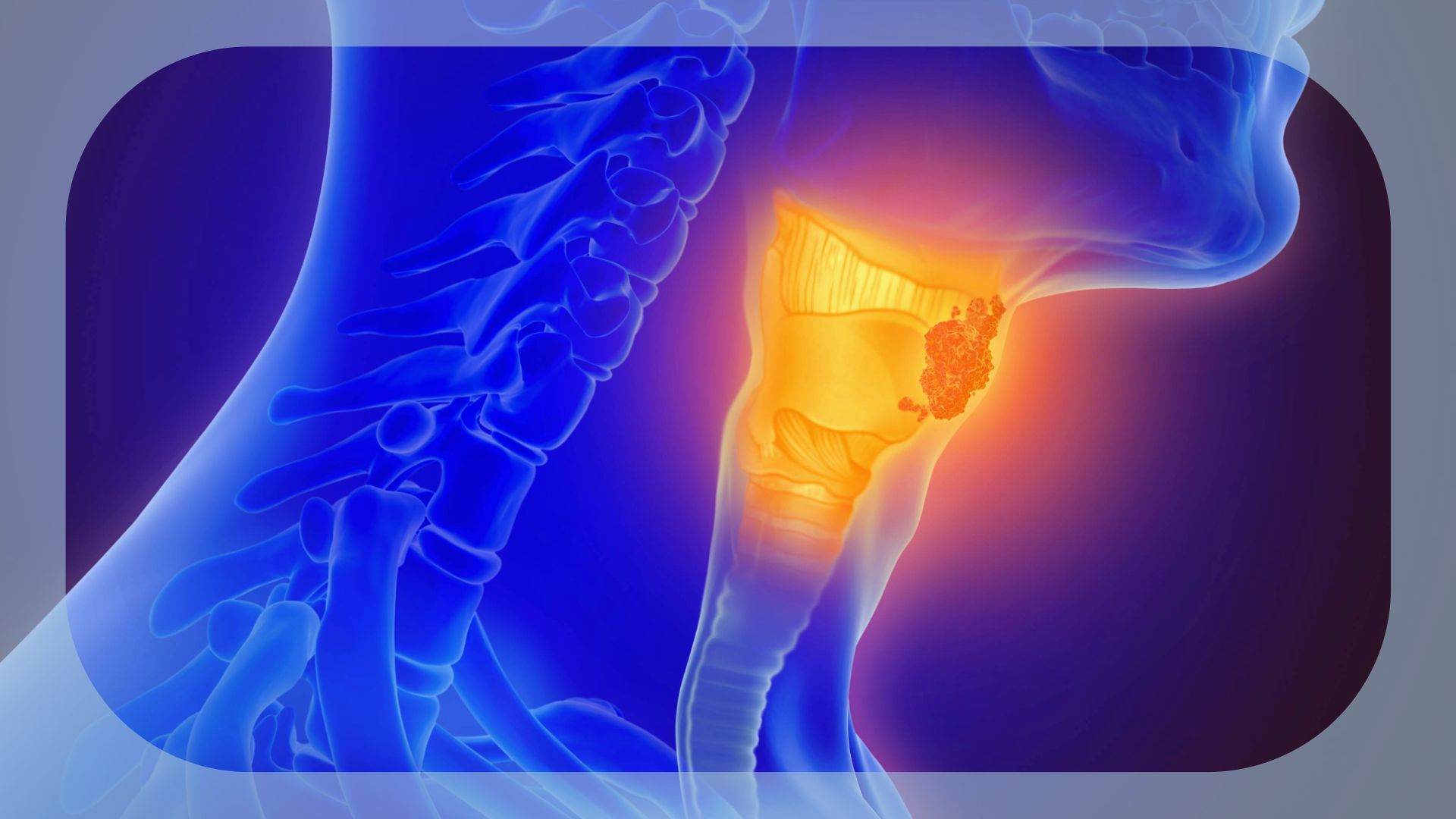 Thyroid Cancer | Image credit:  © Lars Neumann - stock.adobe.com